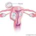 Fibroids No More Fibroids No More