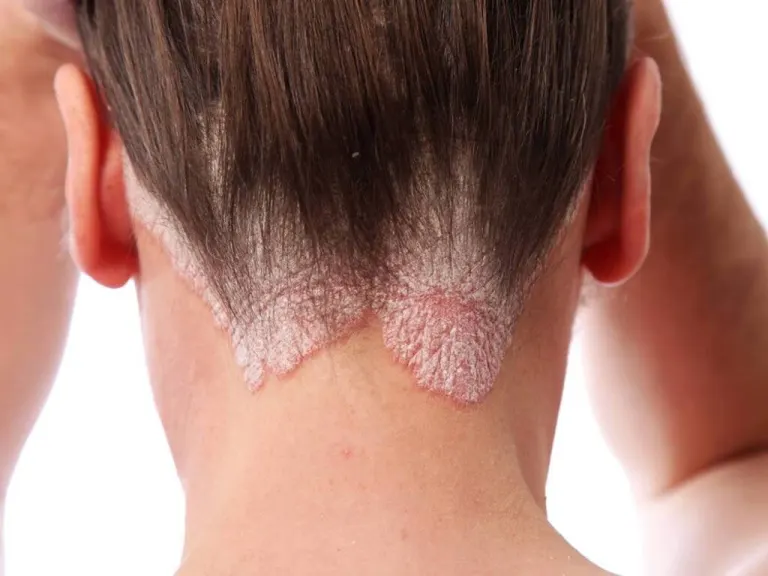 Psoriasi: i benefici del silicio