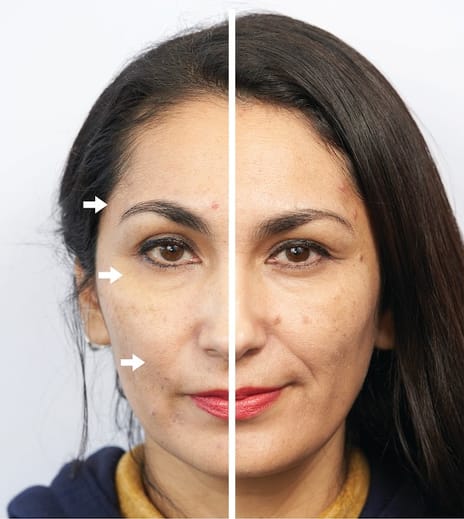 Galvanic Facial Device — Left: after · Right: before