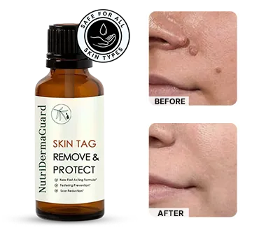NutriDerma Guard Skin Tag Remover Results