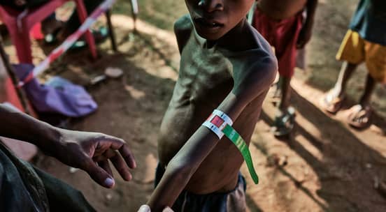 Foto av et tynt, underernært barn på Madagaskar
