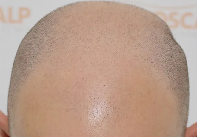 SMP Male Before