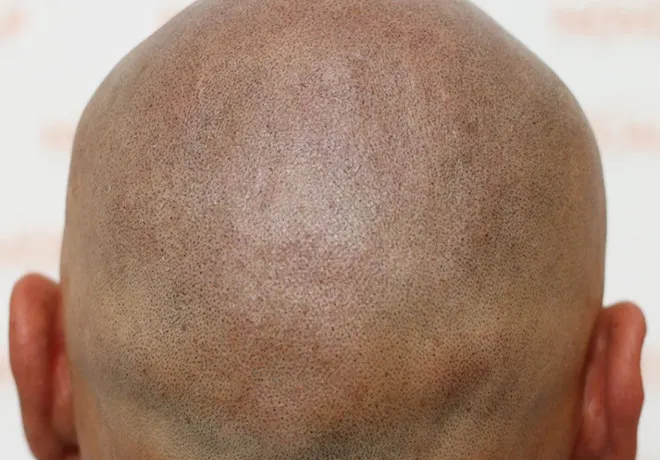 SMP Male After Client 5