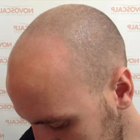Hair Tattoo Before