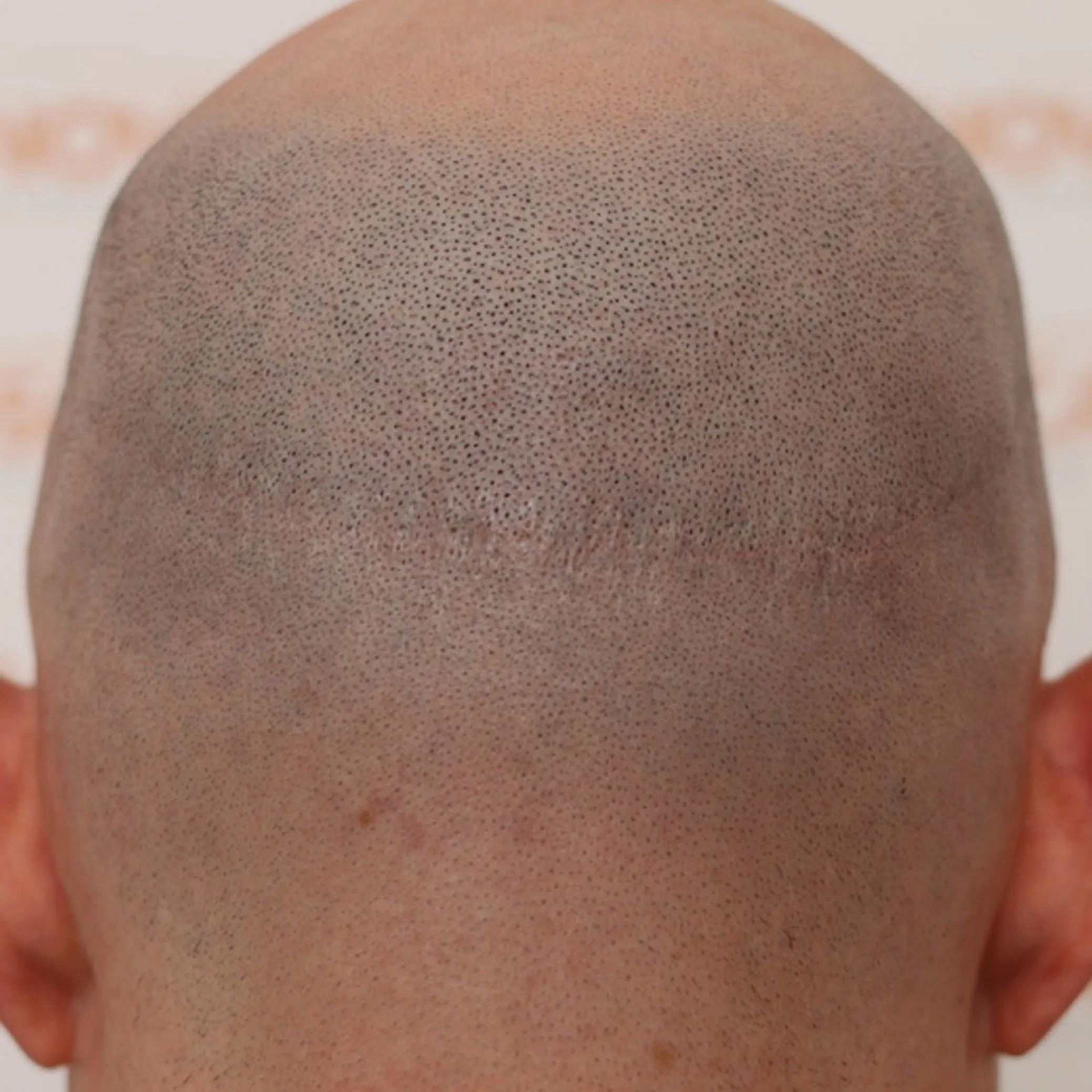 SMP For Scar Camouflage - Novoscalp | SMP Clinics Australia SMP For Scar Camouflage - Novoscalp | SMP Clinics Australia
