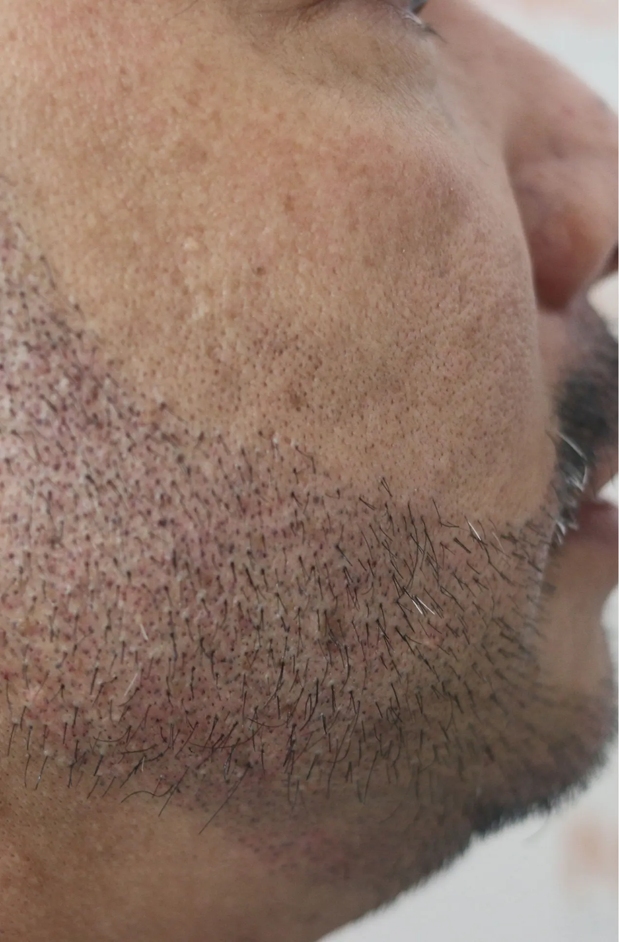 FMP for beard after image