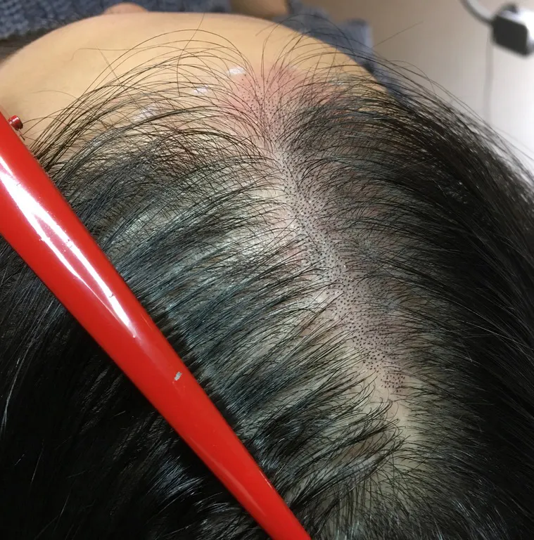 scalp micropigmentation adelaide