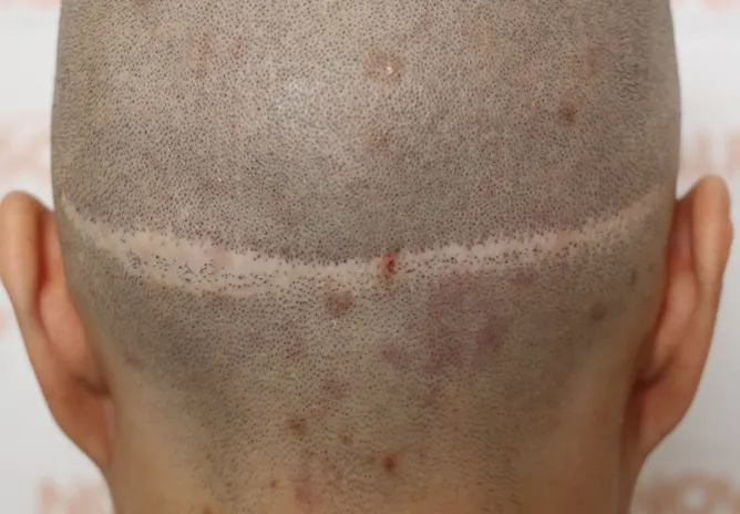Scar Camouflage before SMP Scalp Micropigmentation