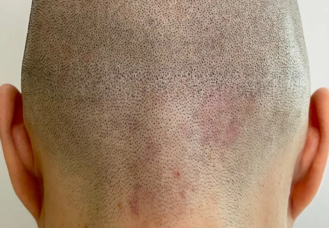 Scar Camouflage after SMP Scalp Micropigmentation
