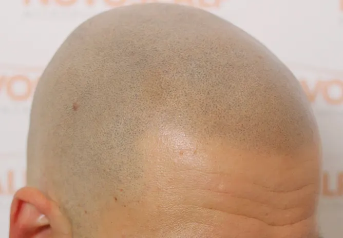 SMP for the Shaved Head Look SMP for men After