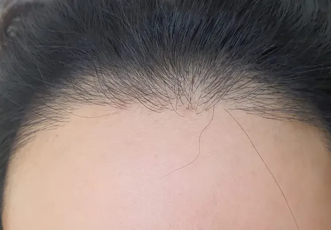Female Hairline SMP Before Womens SMP Scalp Micropigmentation