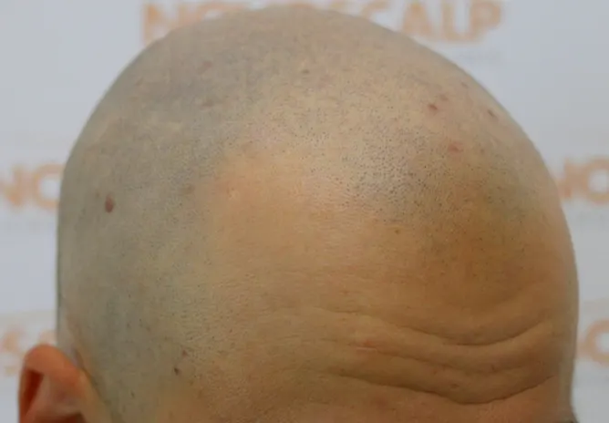 SMP for the Shaved Head Look SMP for men Before