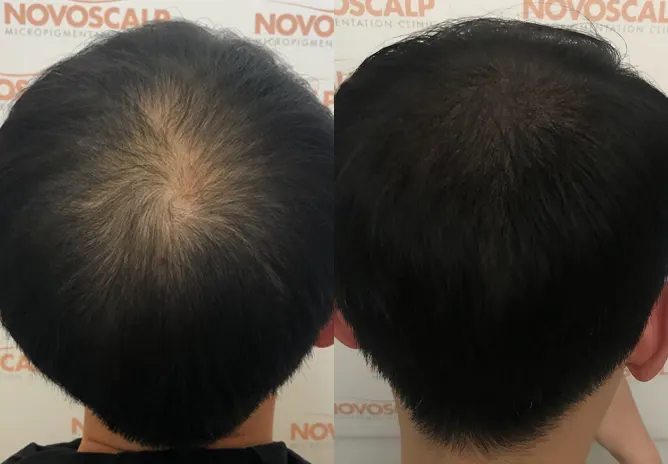SMP for longer hair in men - Novoscalp | SMP Clinics Australia SMP for longer hair in men - Novoscalp | SMP Clinics Australia