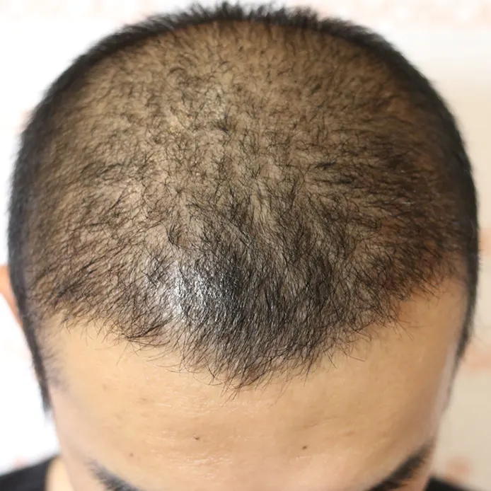 SMP For Transplant Enhancement - Novoscalp | SMP Clinics Australia SMP For Transplant Enhancement - Novoscalp | SMP Clinics Australia