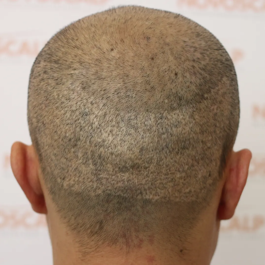 SMP For Transplant Enhancement - Novoscalp | SMP Clinics Australia SMP For Transplant Enhancement - Novoscalp | SMP Clinics Australia