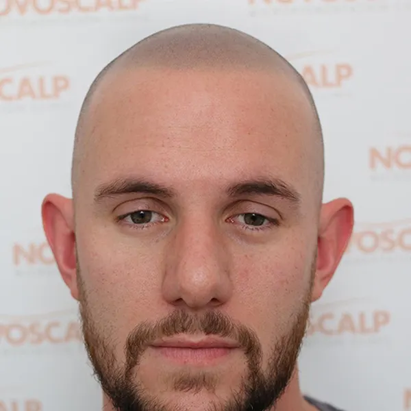 SMP For The Shaved Look - Novoscalp | SMP Clinics Australia SMP For The Shaved Look - Novoscalp | SMP Clinics Australia