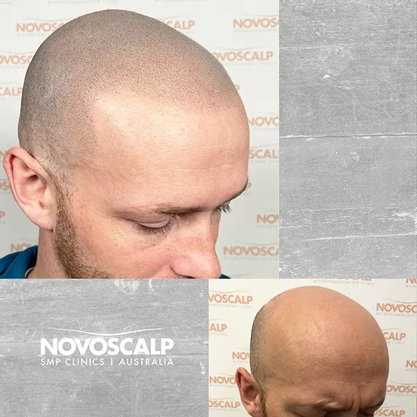 The Ultimate Guide to SMP - Novoscalp | SMP Clinics Australia The Ultimate Guide to SMP - Novoscalp | SMP Clinics Australia