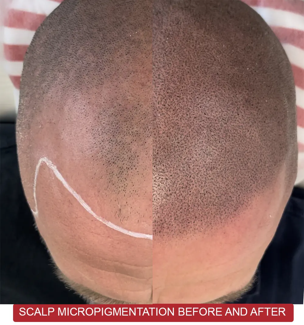 Scalp micropigmentation before and after hair tattoo sydney