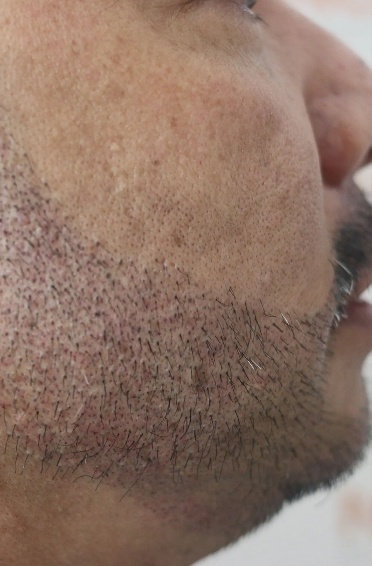 FMP for beard after image