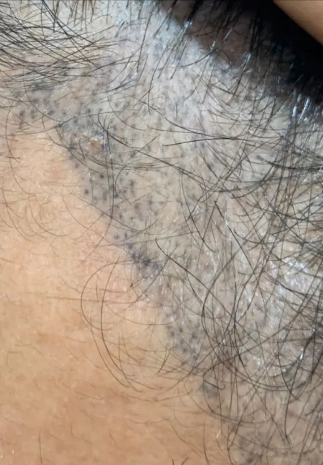 Novoscalp Scalp Micropigmentation Correcting Bad SMP