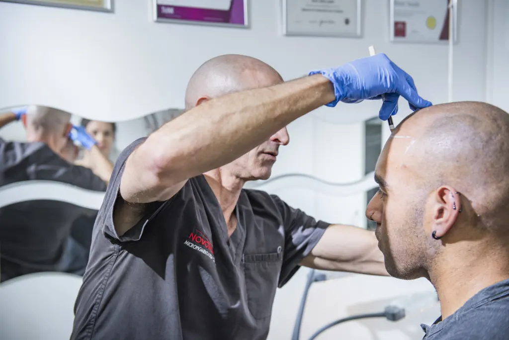SMP Technician Applying Scalp Micropigmentation Outline