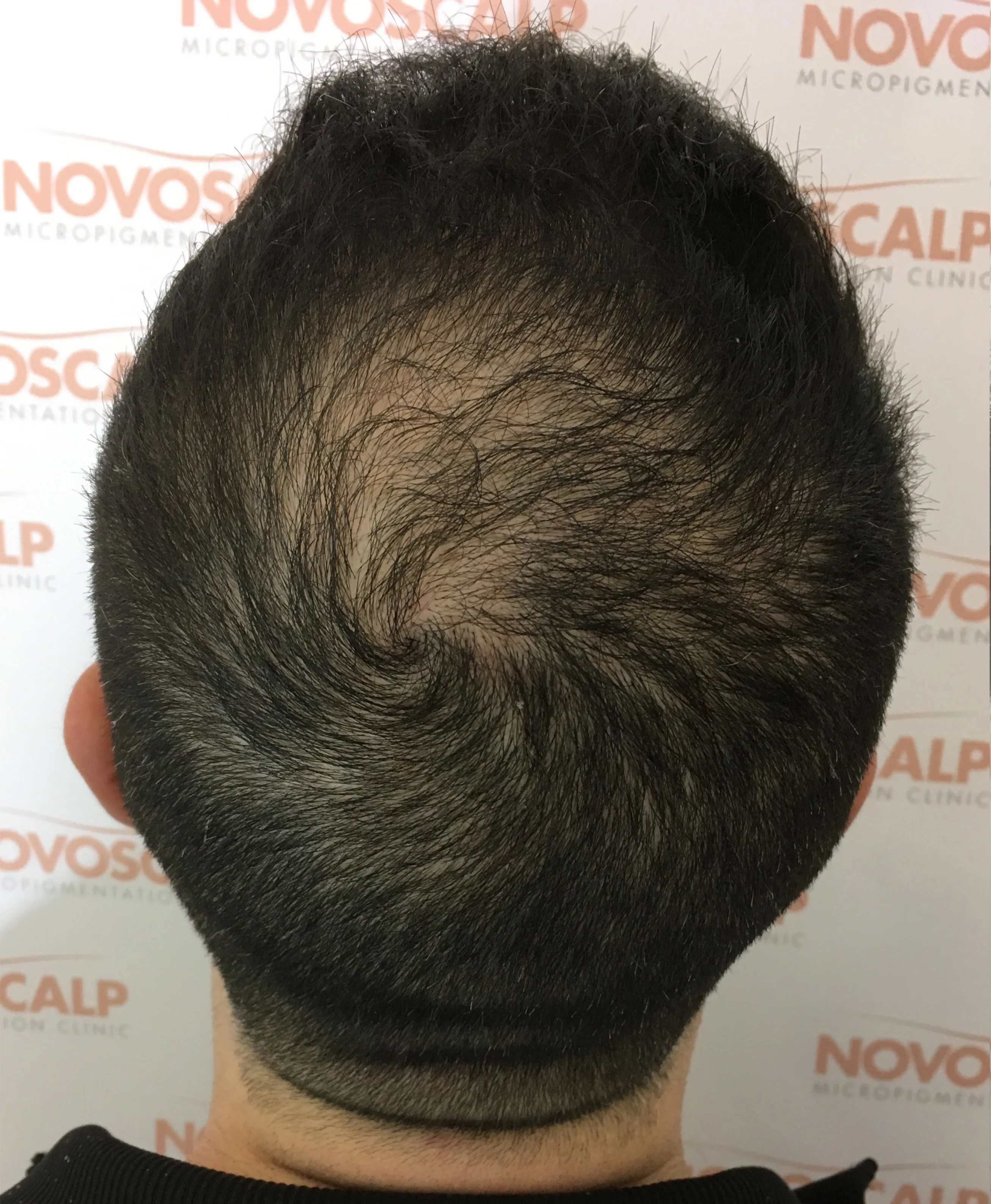 Novoscalp Long Hair SMP Before
