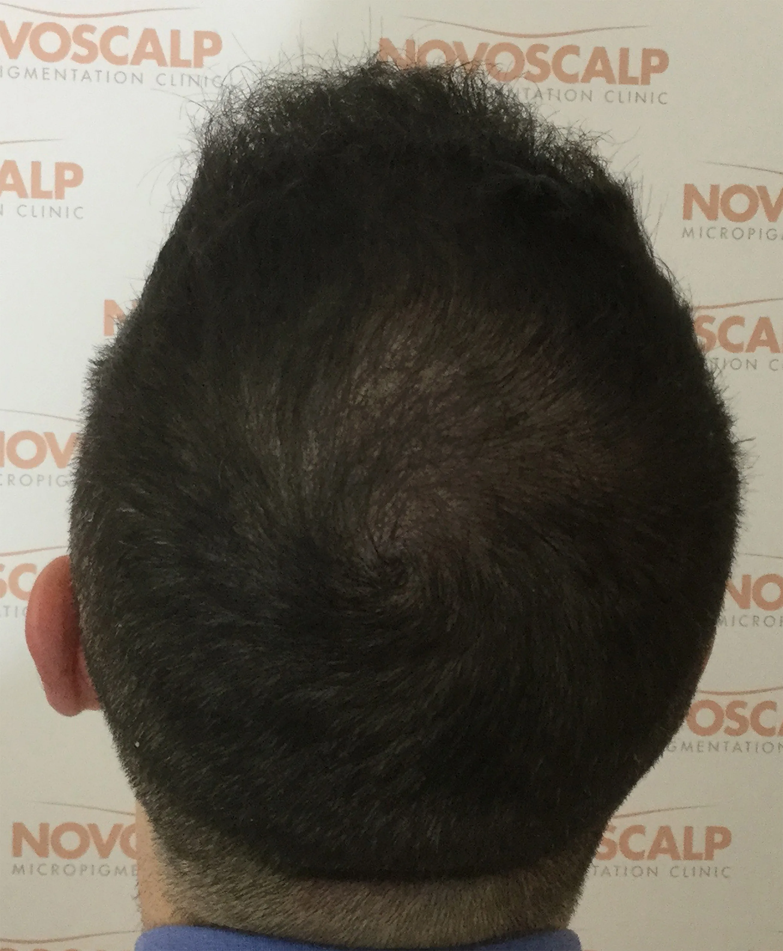 Novoscalp Long Hair SMP After