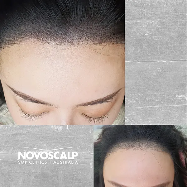 Scalp micropigmentation before and after female hairline tattoo sydney