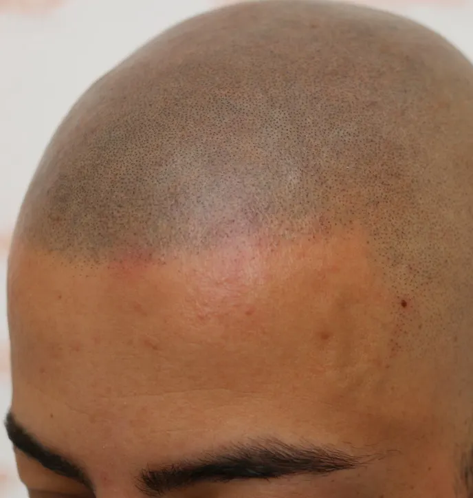 Novoscalp Scalp Micropigmentation Correcting Bad SMP After