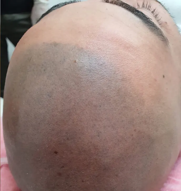 Novoscalp Scalp Micropigmentation Correcting Bad SMP Before