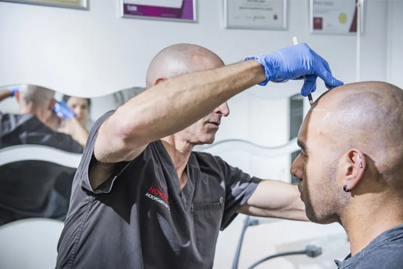 Scalp Micropigmentation Procedure