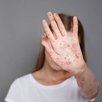 2019 June Feature Measles The Childhood Scourge Is Back 410