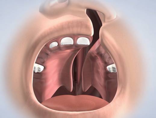 Learn about cleft lip and palate at Columbia Basin Oral & Maxillofacial Surgeons