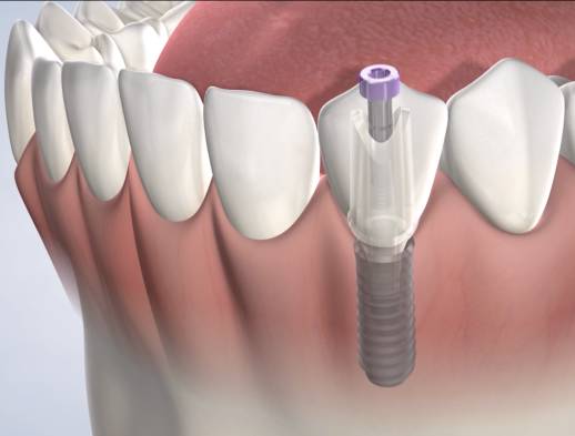 Learn about Trefoil™ at Greater Ventura Oral & Facial Surgery