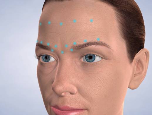 Illustration of face locations where botox can help