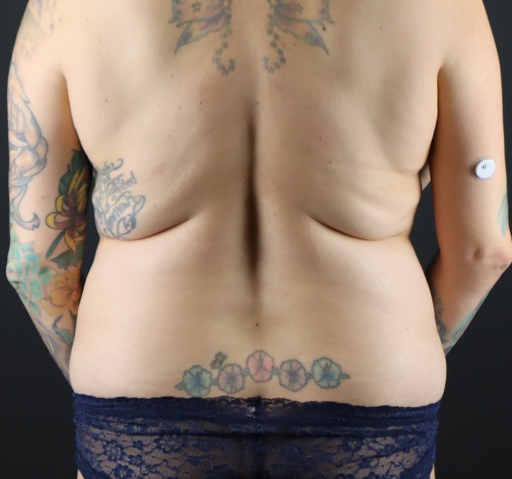 Patient 120 gallery before f