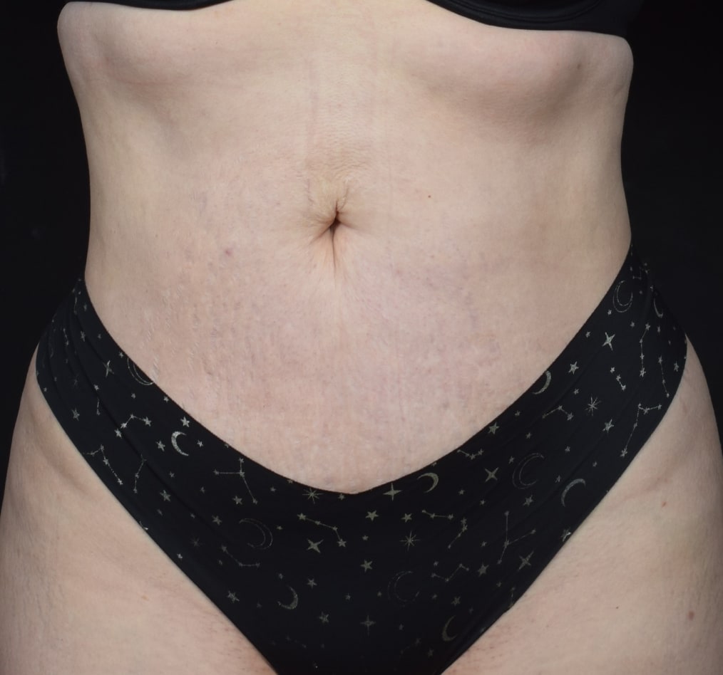 Patient 80 gallery after a