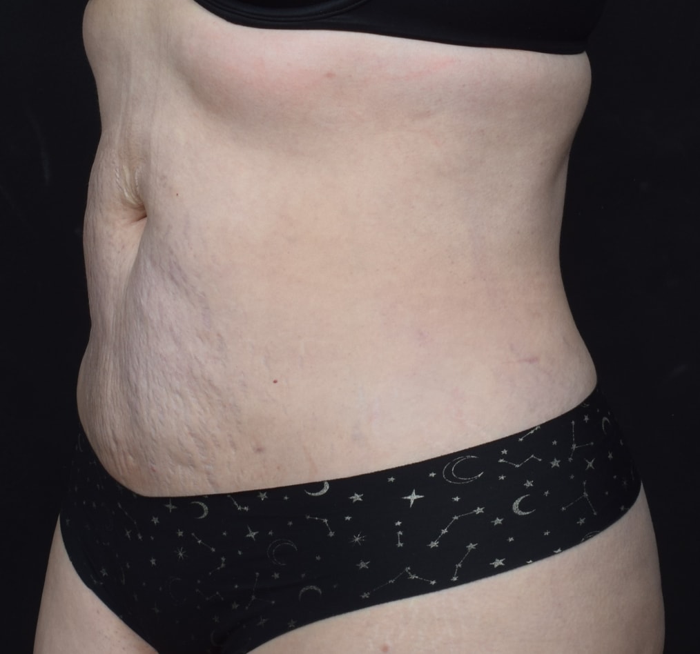 Patient 80 gallery after b