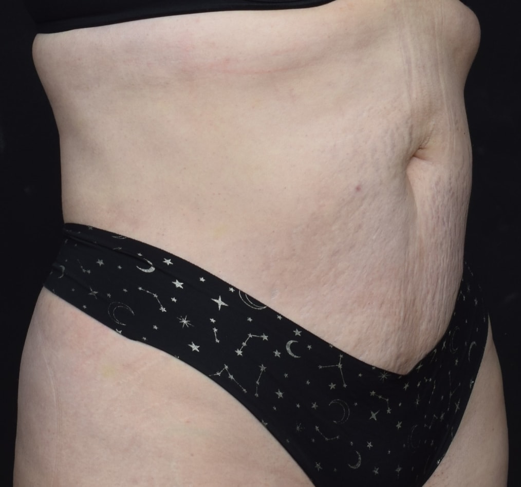 Patient 80 gallery after c