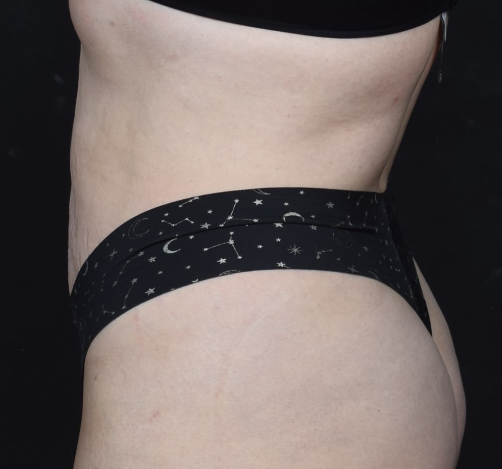 Patient 80 gallery after d