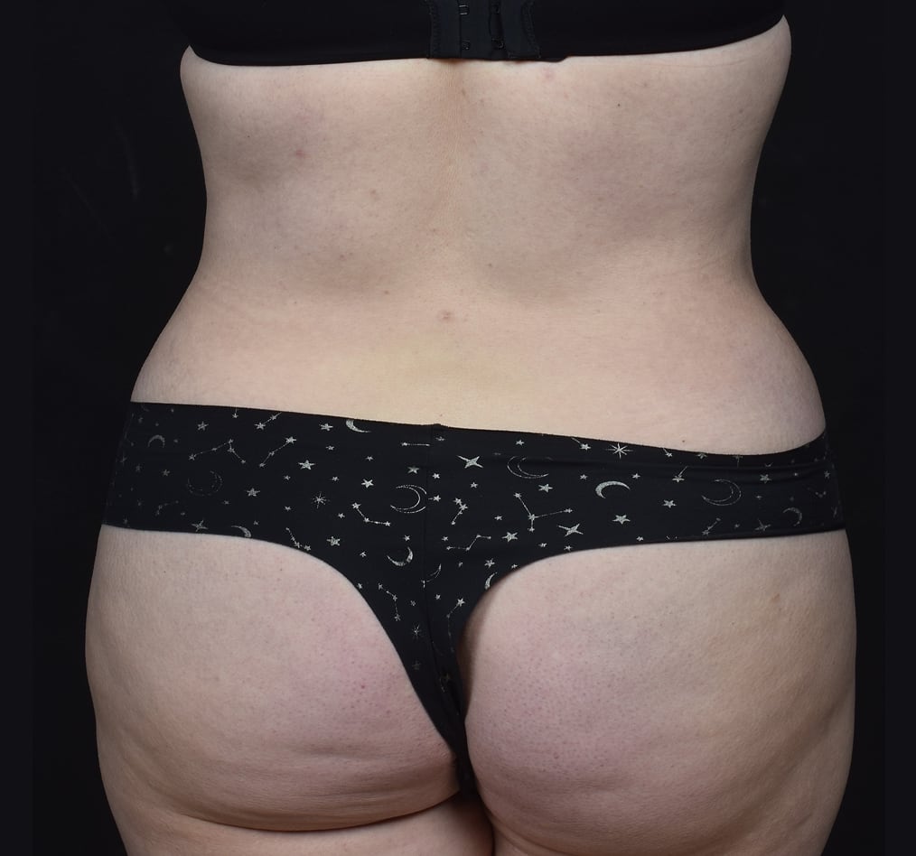 Patient 80 gallery after f