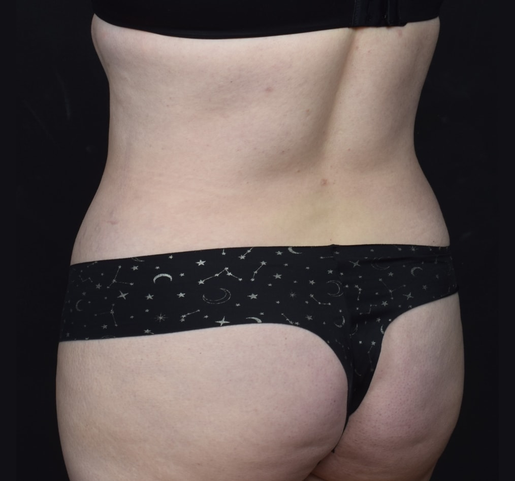 Patient 80 gallery after g