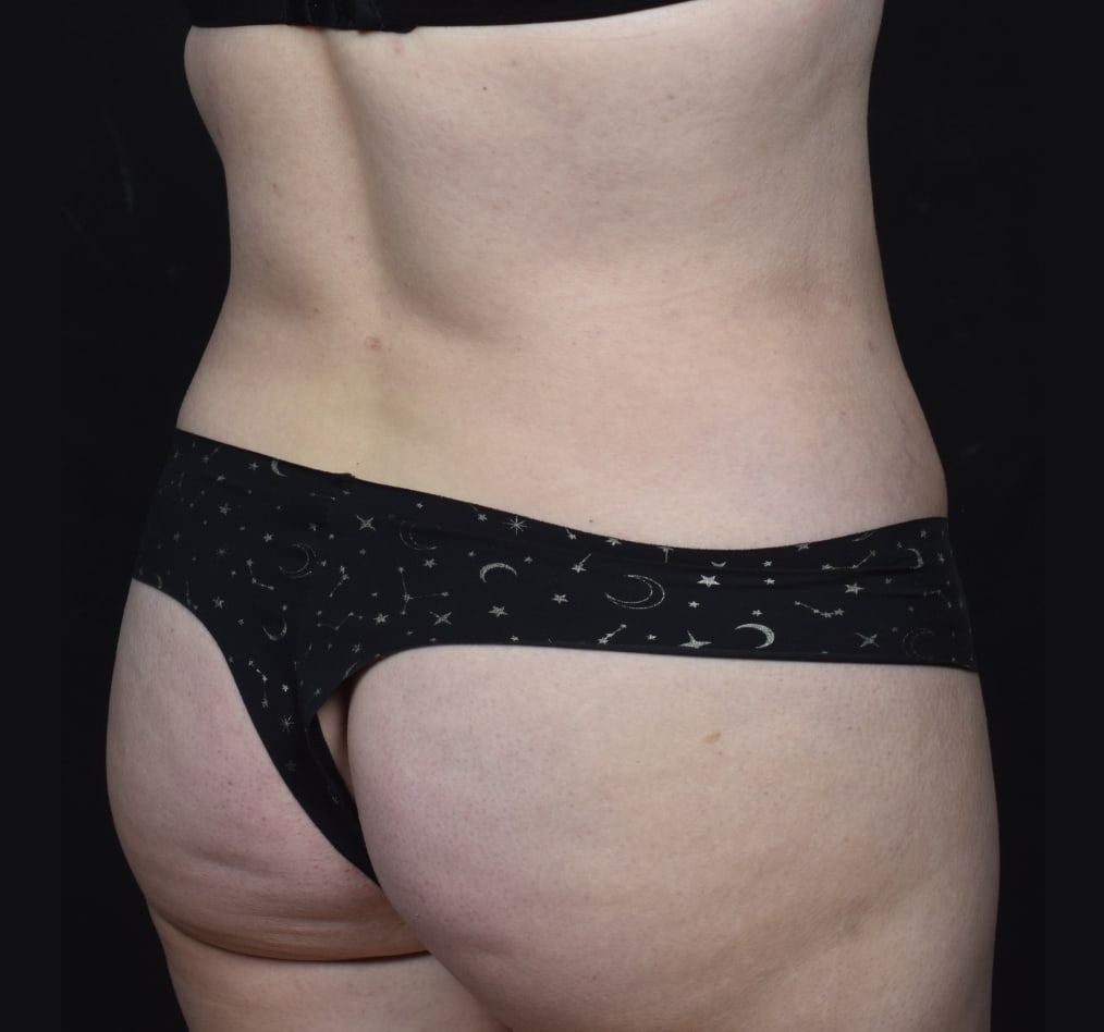 Patient 80 gallery after h