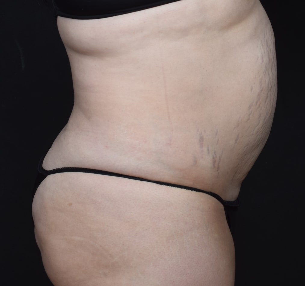 Patient 80 gallery before e