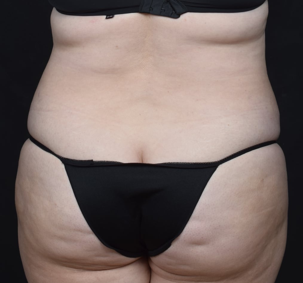 Patient 80 gallery before f