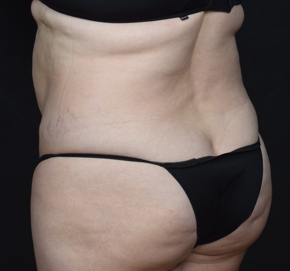 Patient 80 gallery before g