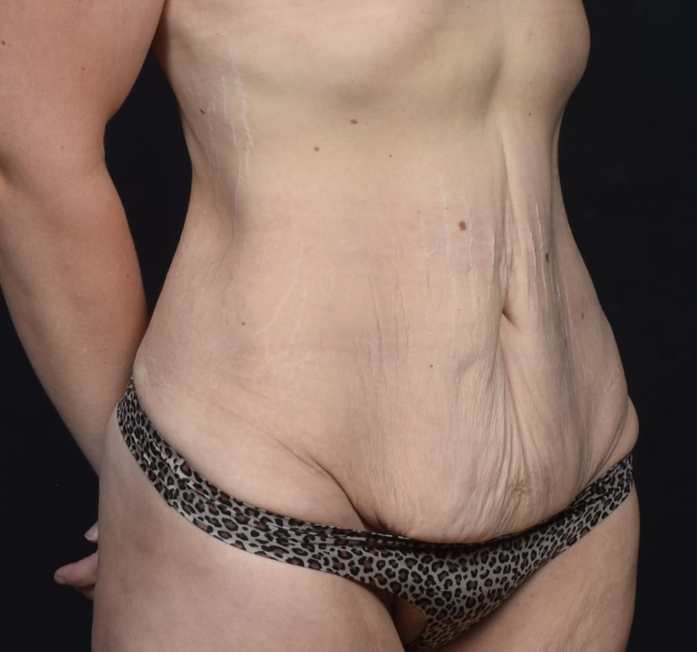 Patient 111 gallery before c