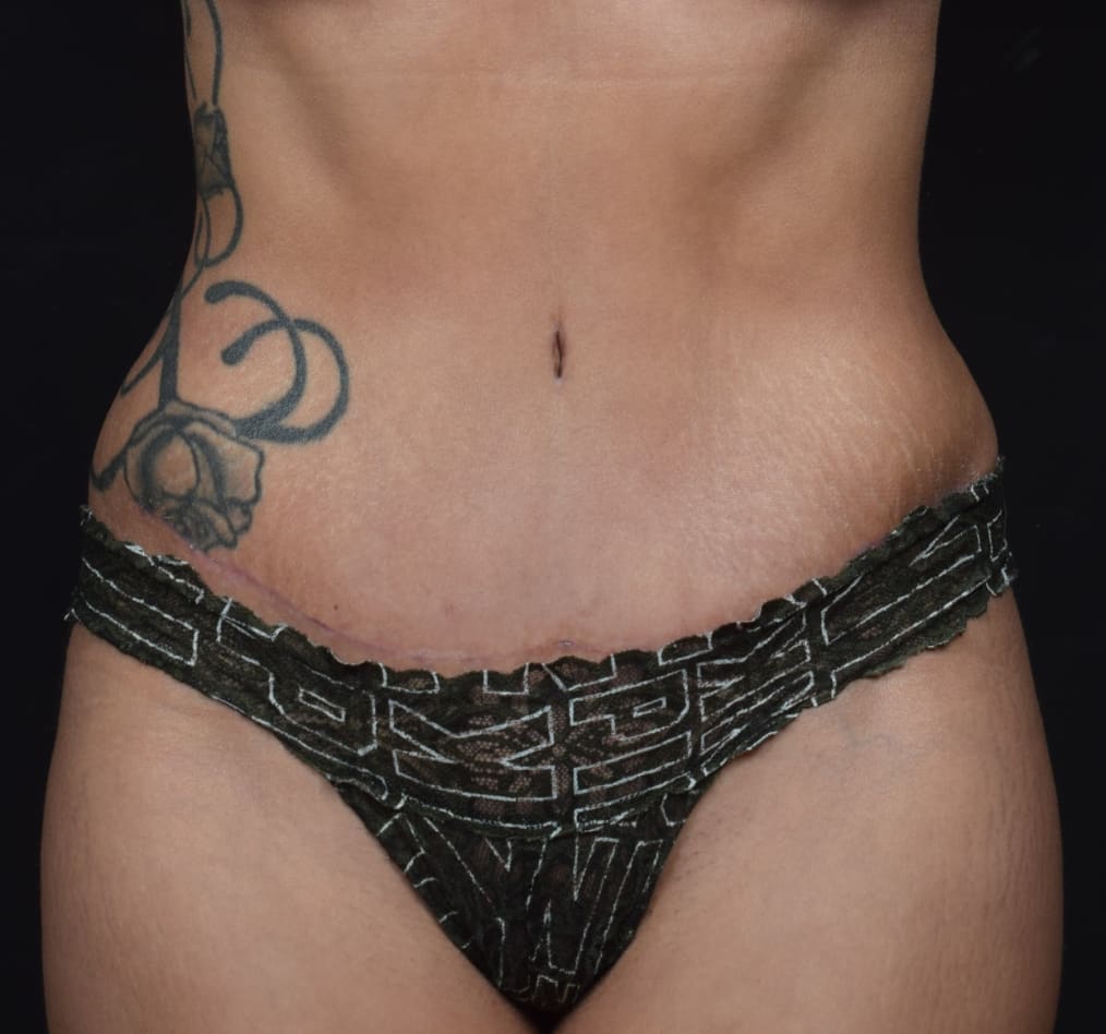 Patient 57 gallery after a