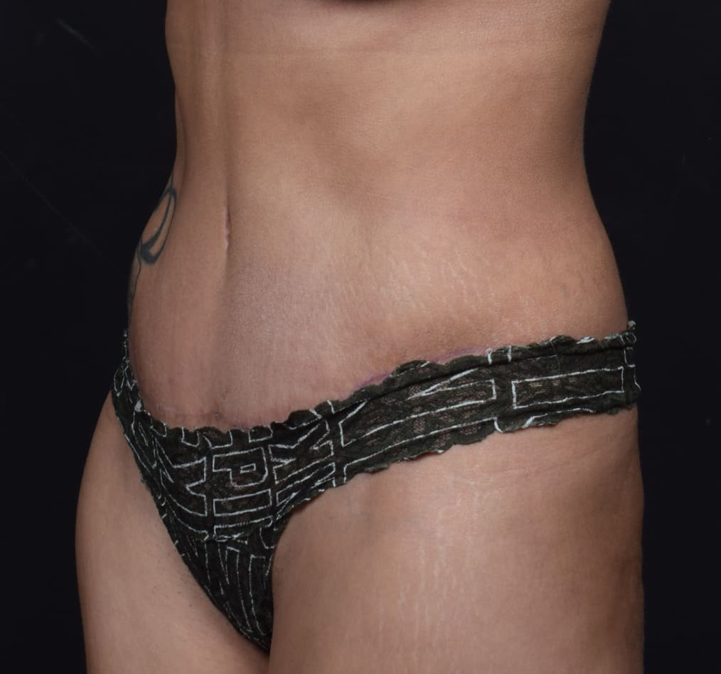 Patient 57 gallery after b