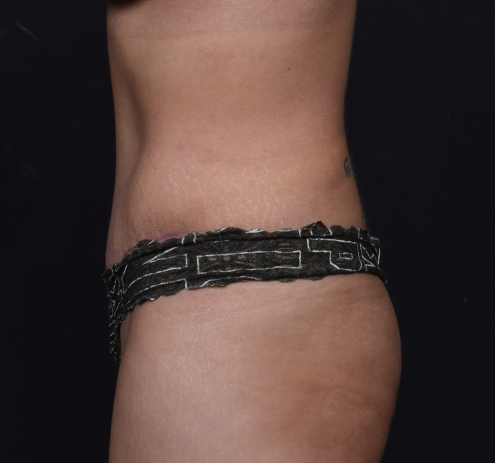 Patient 57 gallery after d